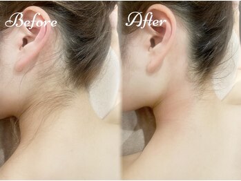 ピミル(PIMIL)/うなじ脱毛