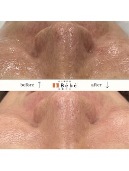 ベベ 大阪中央店(Be’be’)/信じられないくらい変化する肌