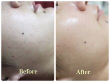 ビビネイル(vivi.NAIL)/バーバルピールbefore after