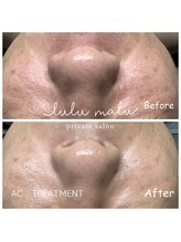 ルルマル(lulumalu)/AC　トリートメント