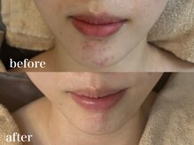 ホワイトアクア 北千住店(WHITE AQUA)/ララピール/毛穴/ニキビケア