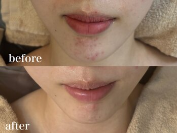 ホワイトアクア 北千住店(WHITE AQUA)/ララピール/毛穴/ニキビケア