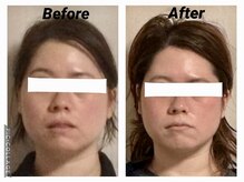 ショウフェイスデザイン(Sho Face Design)/《小顔矯正》ビフォーアフター