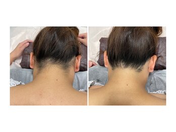 グリーンシャムロック(Green Shamrock)/うなじ脱毛