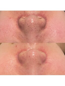 ミューズ(MUSE)/エクストラクション＋美顔フォト