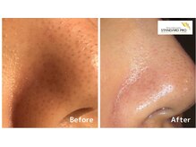 ロージィーローズ(Rosy Rose)/小鼻の黒ずみ解消に◎