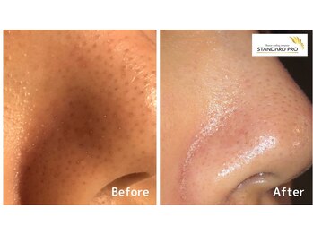 ロージィーローズ(Rosy Rose)/小鼻の黒ずみ解消に◎