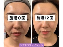 プリュネル(Prunelle)/プラズマシャワー