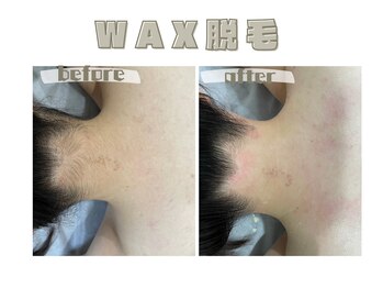 レヴィート(Revept)/【ワックス脱毛】