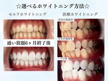 ホワイト 福岡天神店(WHITE)の雰囲気（お悩み、仕上がりの白さによって選べるホワイトニング方法！）