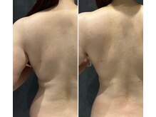 エトワール(etoile)/背中ハーブピーリング