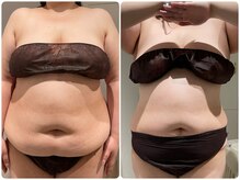 イデアルミー 大宮店(イデアルMe)/痩身エステ3ヶ月間Before　After