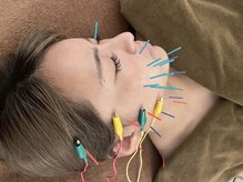 松戸駅前鍼灸院 整骨院の雰囲気（美容鍼でお顔すっきり【たるみ改善/むくみ改善/リフトアップ】）