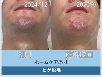 アロマ(AROMA)/ニキビ×ヒゲ脱毛が同時に叶う