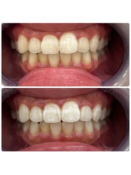 グリッター ショウナン(glitter. SHONAN)/藤沢ホワイトニングbefore/after