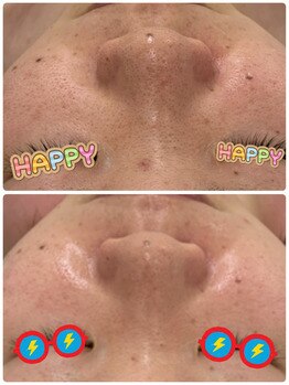 ソワンマリア(soin Maria)/毛穴改善3回の効果です♪