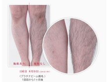 ルポゼ(Re:poser)/足脱毛 
