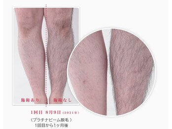 ルポゼ(Re:poser)/足脱毛 