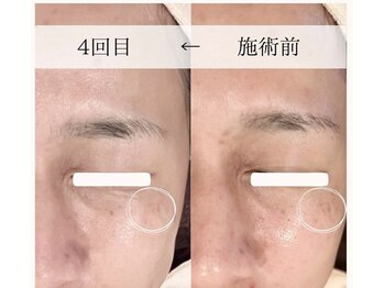 ニコ ウィズ(Nico with)/シミケア＋高濃度美容液導入