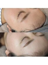 フォルス 天王寺(fors)/ トーンアップするワックス脱毛