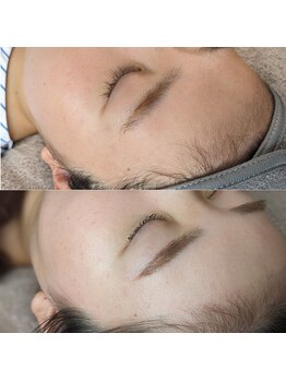 フォルス 天王寺(fors)/ トーンアップするワックス脱毛