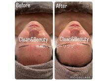 クリーンアンドビューティ 札幌(Clean&Beauty)/肌改善ゴールのプロセスです♪