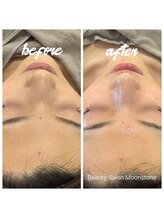 ムーンストーン(Moonstone)/プラピール　ビフォーアフター