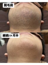 アカラ 読谷店(AKALA)/ヒゲ脱毛1ヶ月半