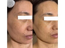 エクレクティック(ECLECTIC)/小顔/たるみ毛穴ケア