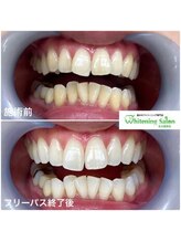 ホワイトニングサロン 名古屋駅店/【ホワイトニング施術例】