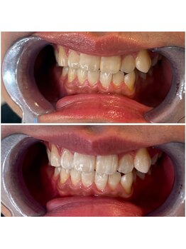 エクシアホワイトニング 代々木店/白い歯は好印象