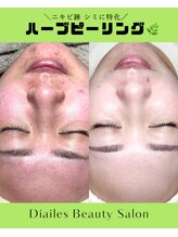 ディエール(Diailes) ハーブ ピーリング