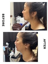 エリシオン(ELYSION)/RFリフトアップ