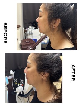 エリシオン(ELYSION)/RFリフトアップ