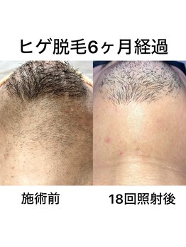 トイヴォ(TOIVO)/脱毛ビフォーアフター!