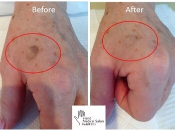 ミーレ(Miele)/手のシミが改善されます！