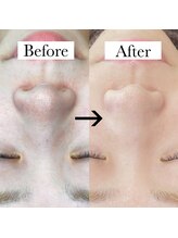 リノア(Linoa)/毛穴洗浄ハイドロフェイシャル