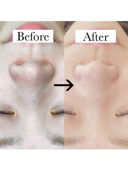 リノア(Linoa)/毛穴洗浄ハイドロフェイシャル