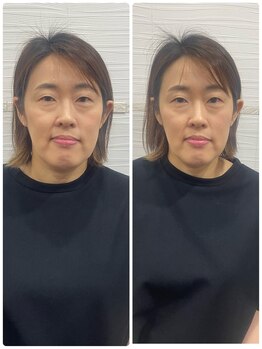 長寿鍼灸院 長寿整骨院/美容鍼25本の効果★小顔効果
