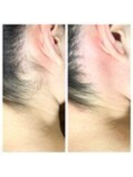 ブラジリアンワックス脱毛専門店 ヴァージン ワックス 新宿店(Virgin Wax)/【うなじ】ビフォーアフター