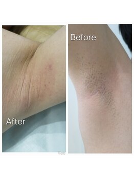 アールスサロン/ワキ脱毛