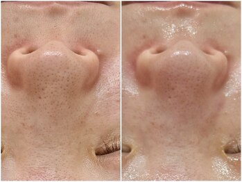 リノア(Lino'aka)/毛穴トルネード洗浄５回の結果