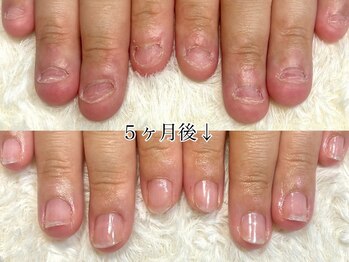 グラシナ 名古屋金山店/(深爪／長さだし/フィルイン)
