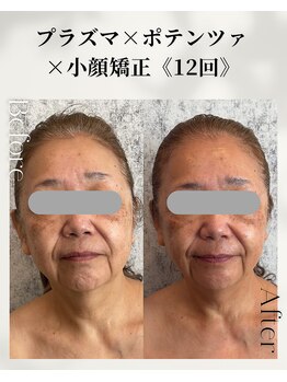 ドゥシール(Docile)/60代女性｜たるみ・姿勢改善