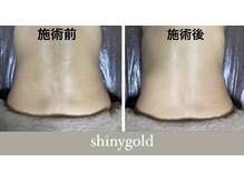 シャイニーゴールド 新所沢店(Shiny GOLD)/1回でも驚きの引き締め効果◎