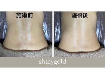 シャイニーゴールド 新所沢店(Shiny GOLD)/1回でも驚きの引き締め効果◎
