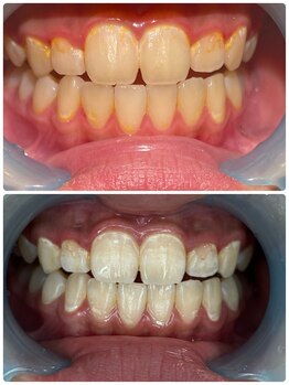 モゼ(moze)/美白ホワイトニング