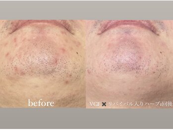 クレヴィー(Creviy)/メンズ陶肌トリートメント1回