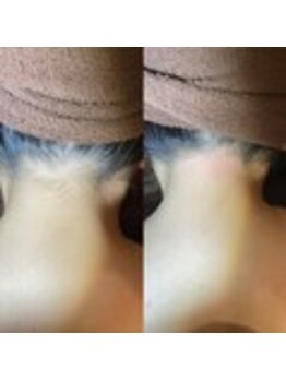 ブラジリアンワックス脱毛専門店 ヴァージン ワックス 新宿店(Virgin Wax)/【うなじ】ビフォーアフター