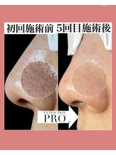 ハナノワ(花のWA)/毛穴図鑑